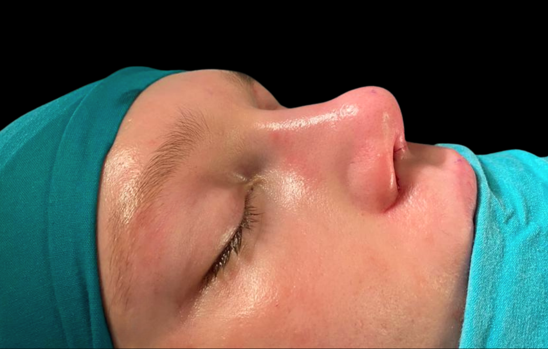 Septoplasti antalya ,Septoplasti Ameliyatı nasıl yapılır